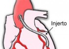 Bypass: un puente entre arterias | Recurso educativo 760002